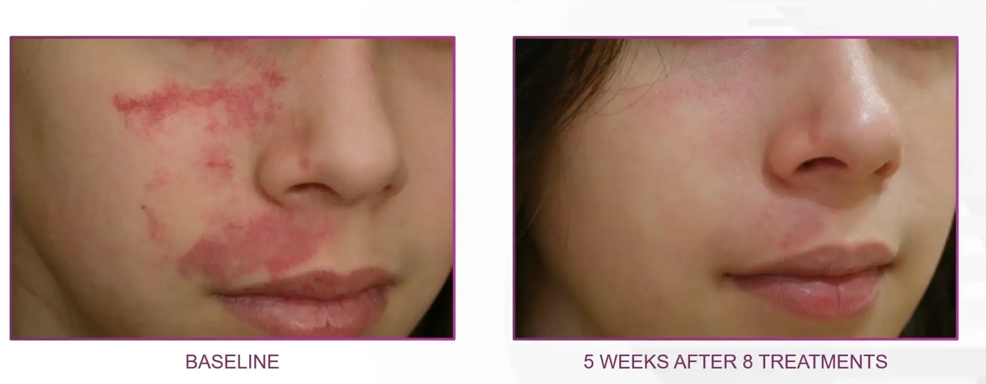 Rosacea before and after | Advanced Care & Medspa | Lisle, IL